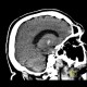 Accumulation of iron in the medial globus pallidus, globus pallidus internus: CT - Computed tomography